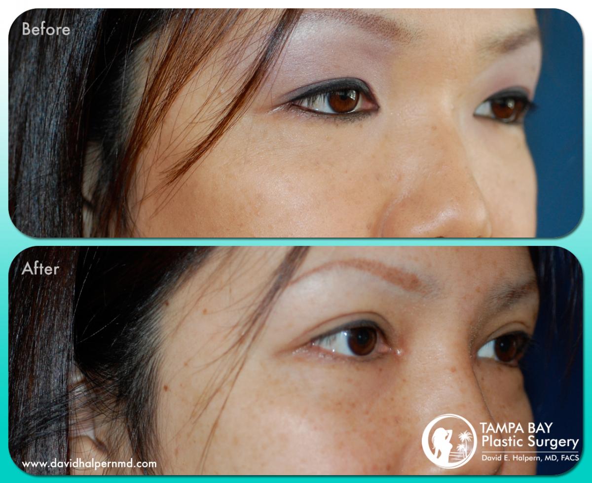 Tampa Blepharoplasty before and after