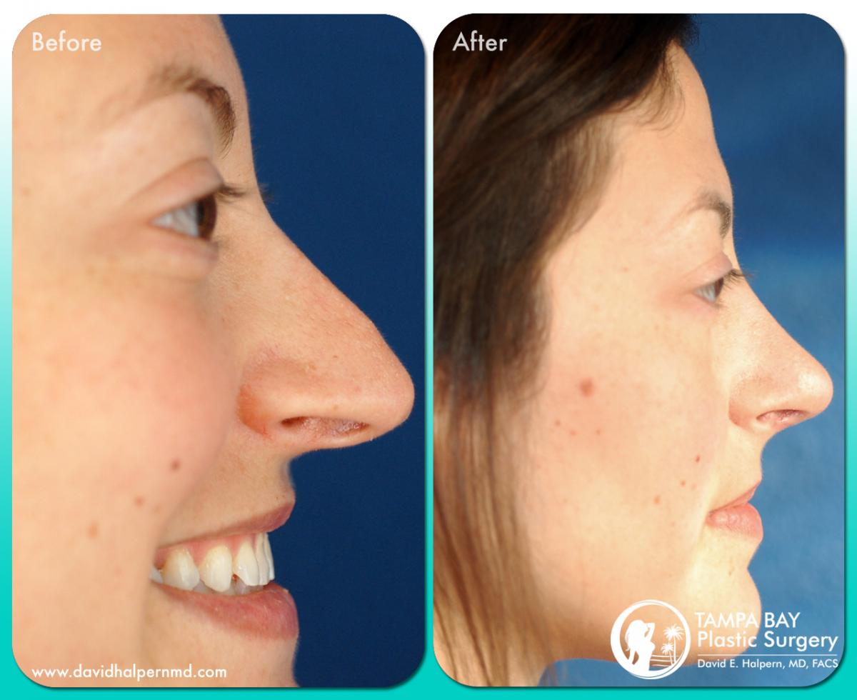 Tampa Rhinoplasty before and after