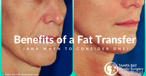 Learn the benefits of a fat transfer also known as fat injections and fat grafting and when you should consider one.