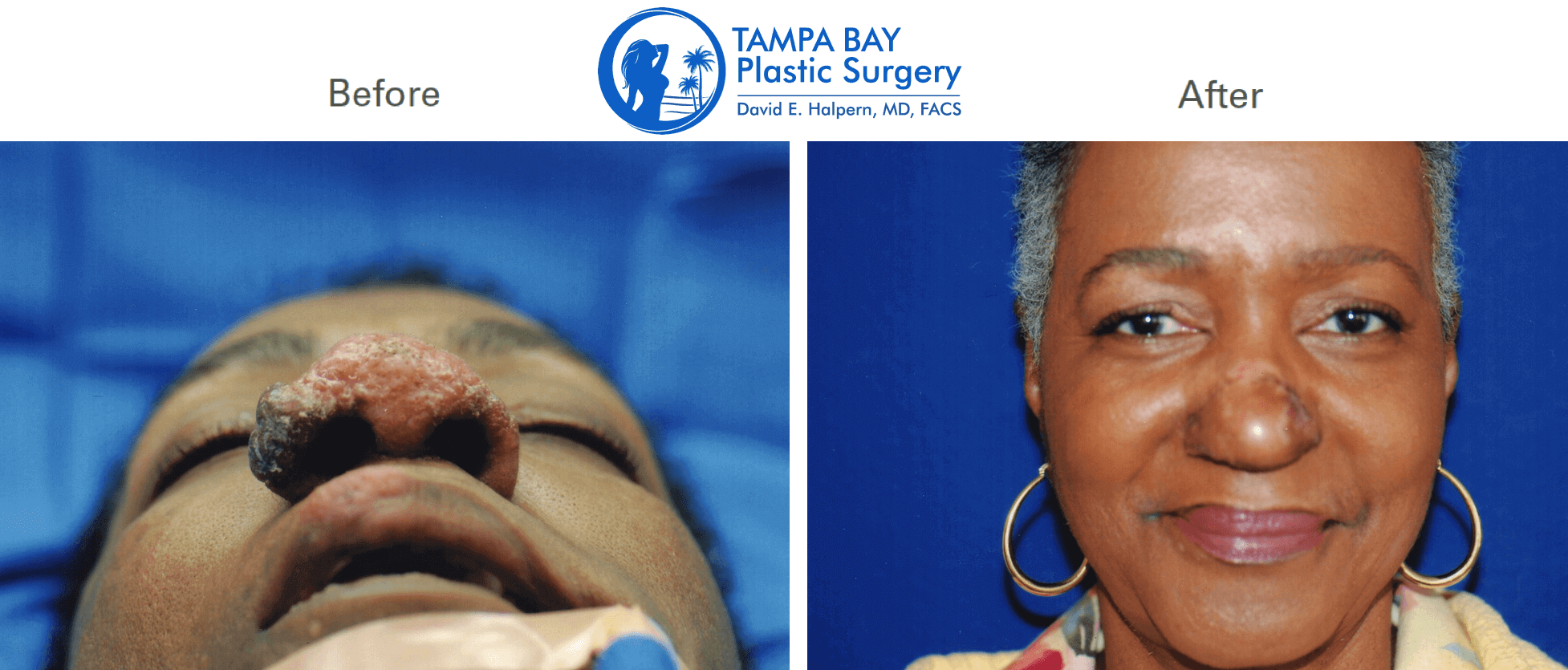 nose-reconstruction-before-after-tampa