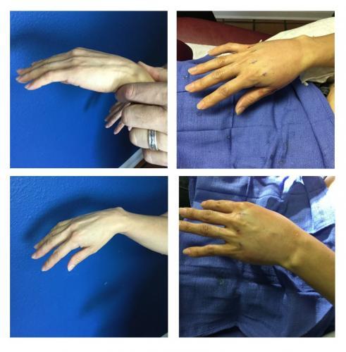 fat-transfer-hands-before-after-tampa