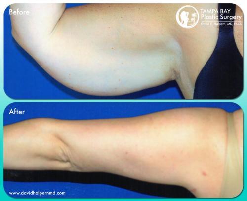 Tampa Brachioplasty Before and After