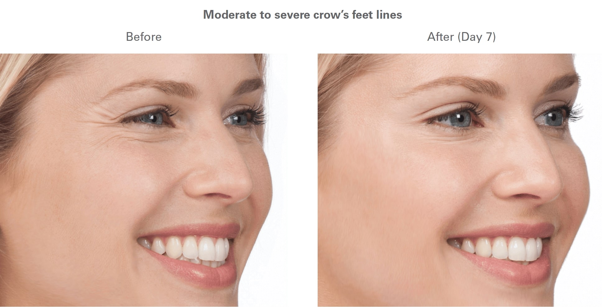 Tampa botox model before and after