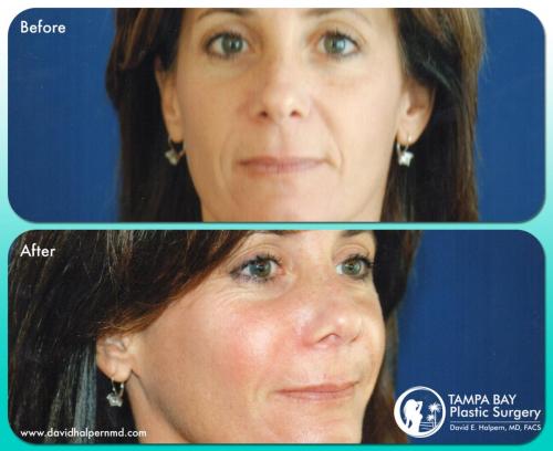 Facial-Fillers-Before-After-Tampa-FL