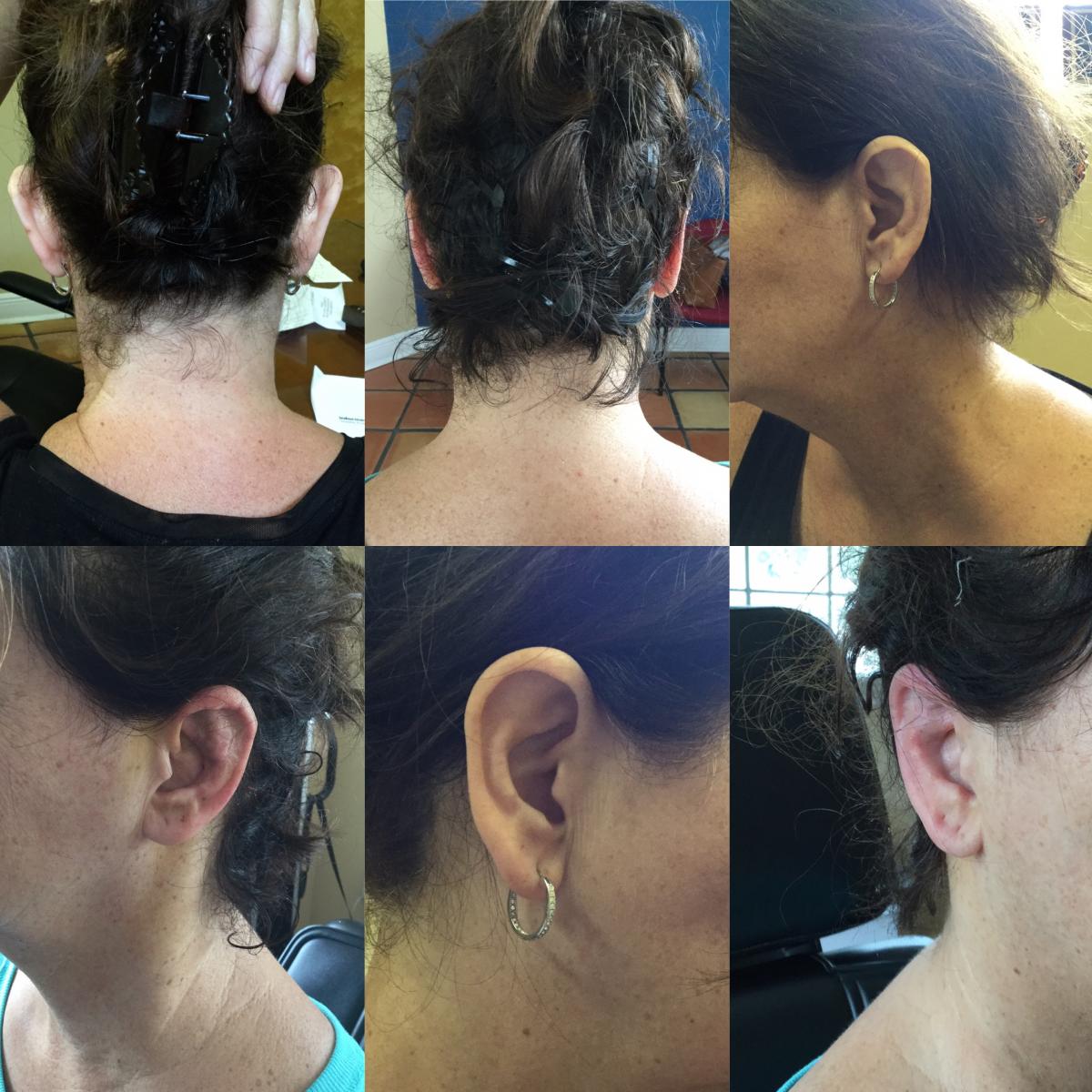 Tampa Otoplasty before and after