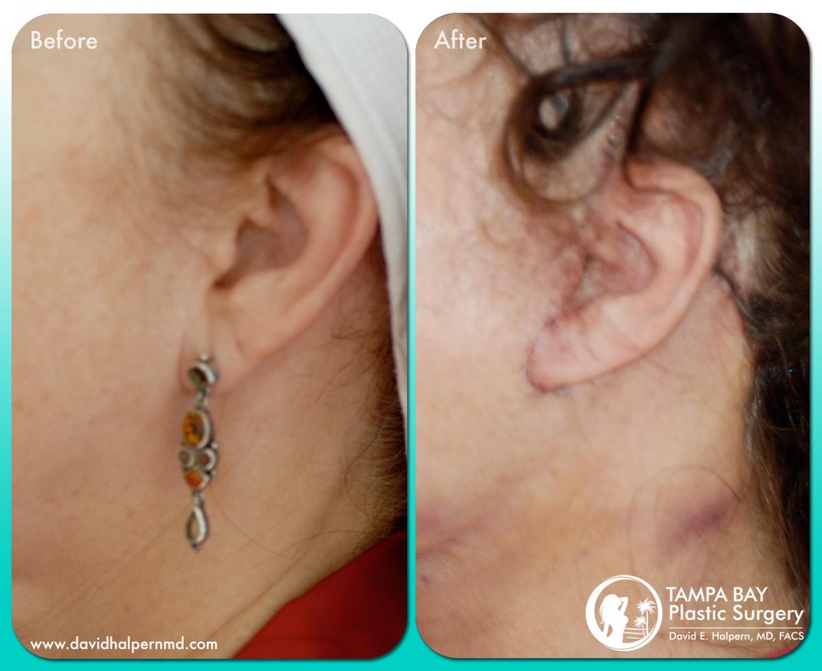 ear-surgery-before-after-tampa