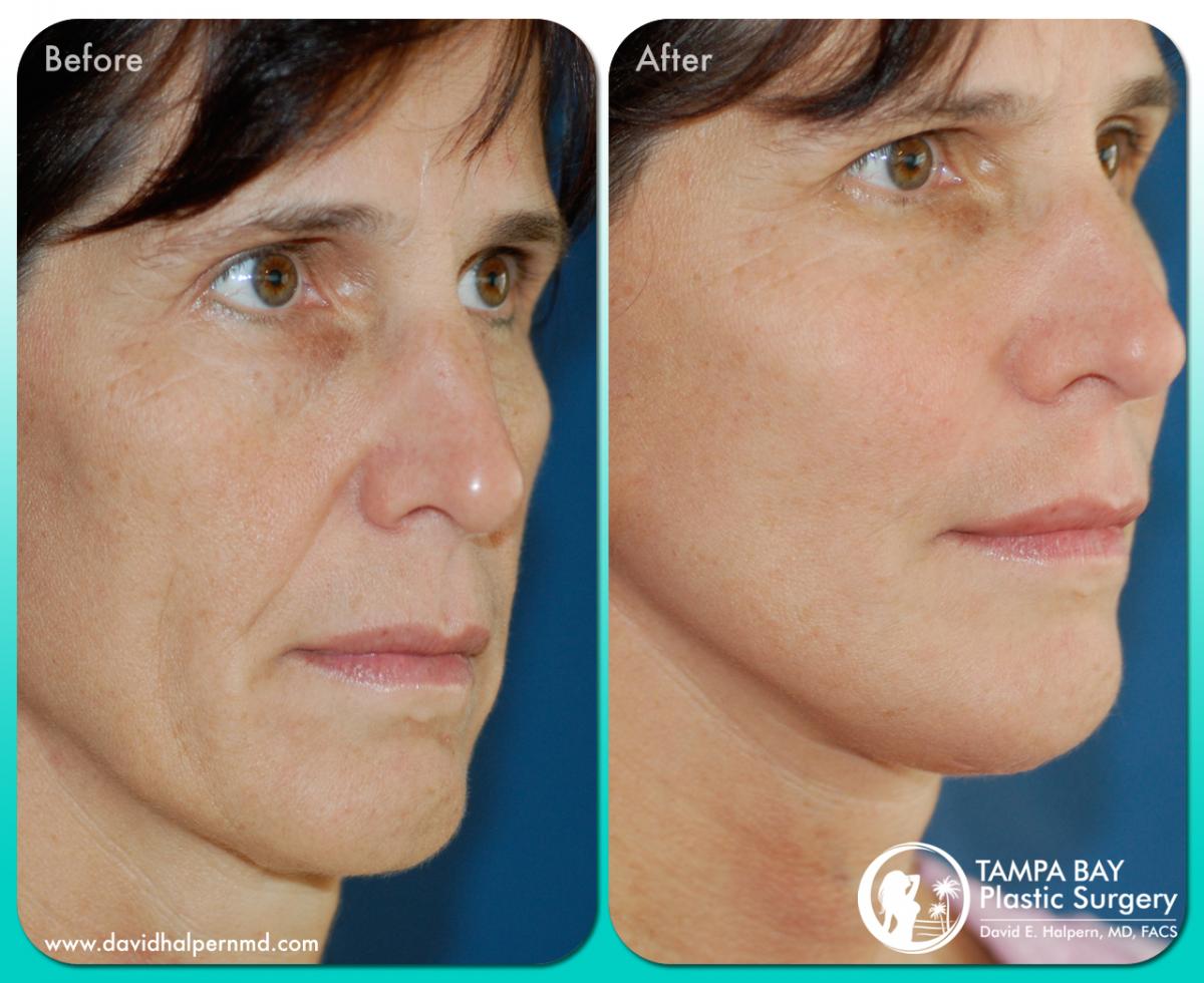 facelift-before-after-tampa