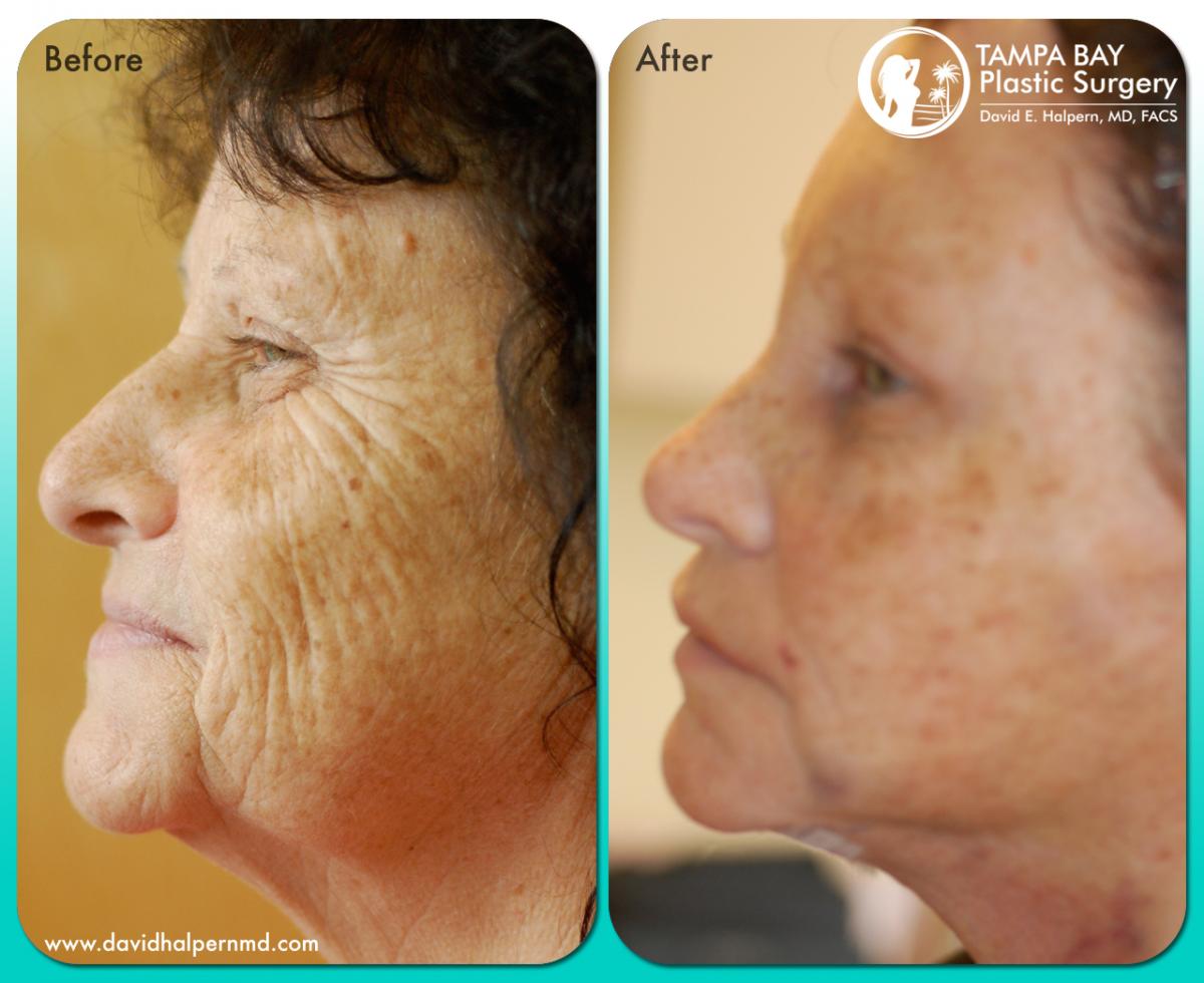 Tampa Facelift patient before and after