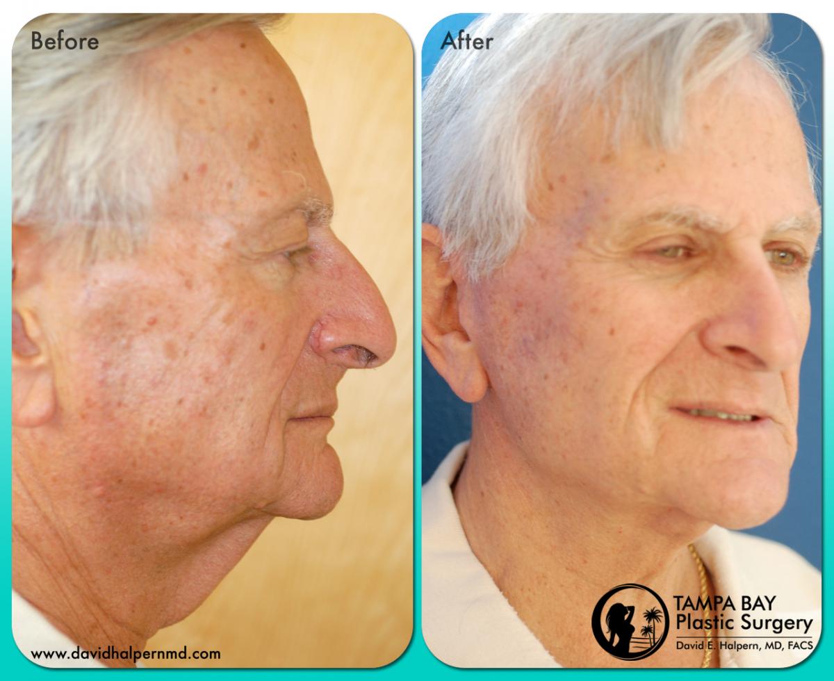 Tampa Facelift patient before and after