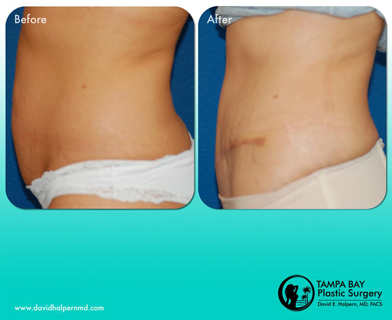 tummy-tuck-before-after-tampa-bay-area