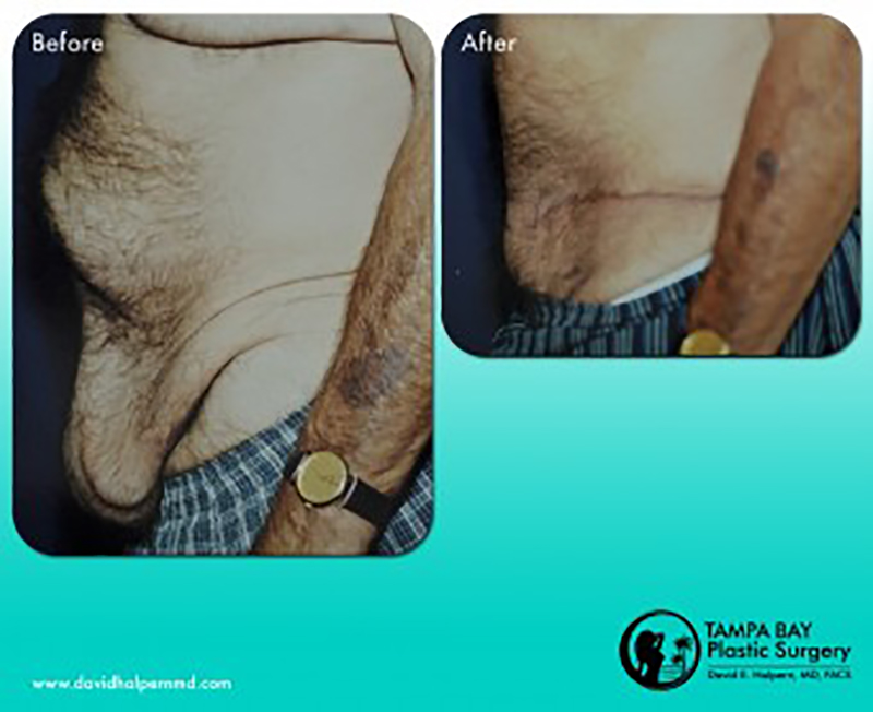 Tampa Tummy Tuck before and after