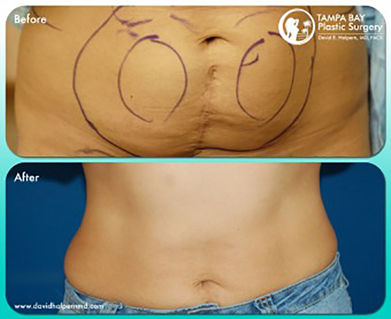 Tampa Tummy Tuck before and after.