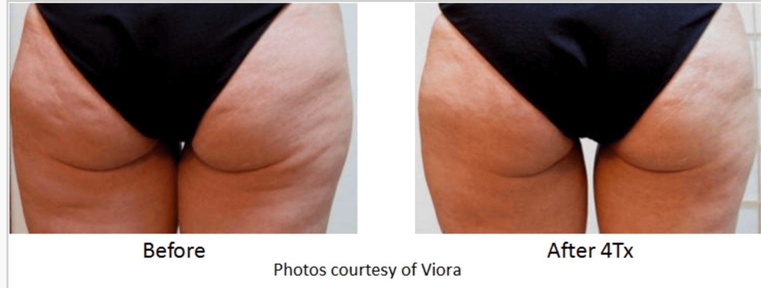 Tampa viora cellulite model before and after