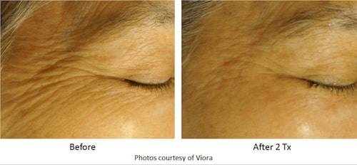 Tampa viora skin tightening model before and after