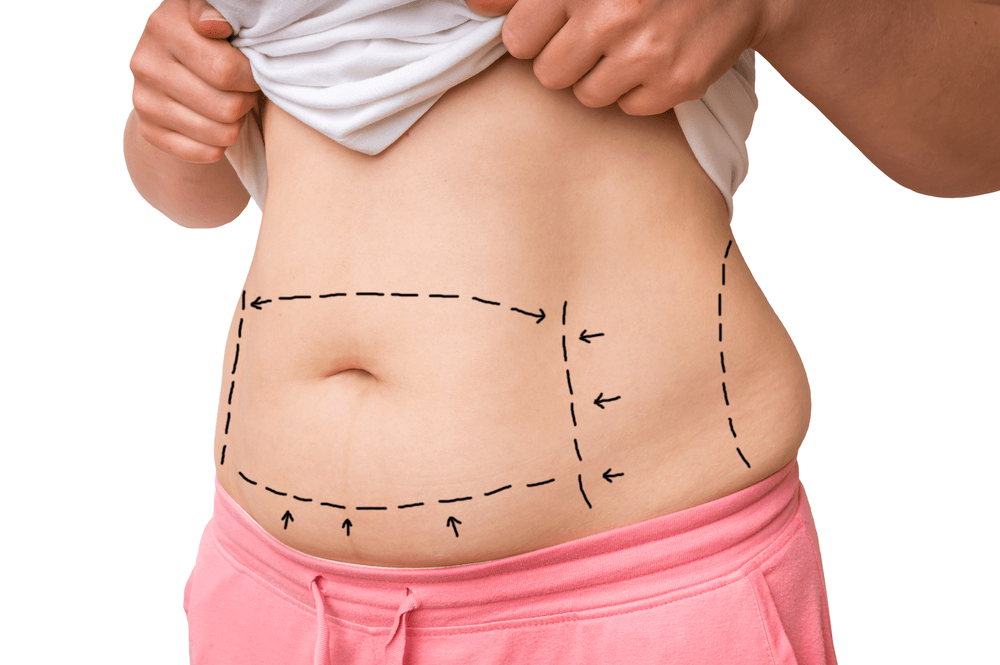 Liposuction (Lipo) Miami, Florida Cost $1500