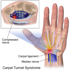 carpal tunnel syndrome