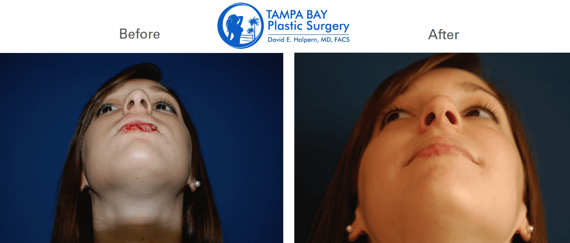 dog bite before after reconstructive surgery tampa