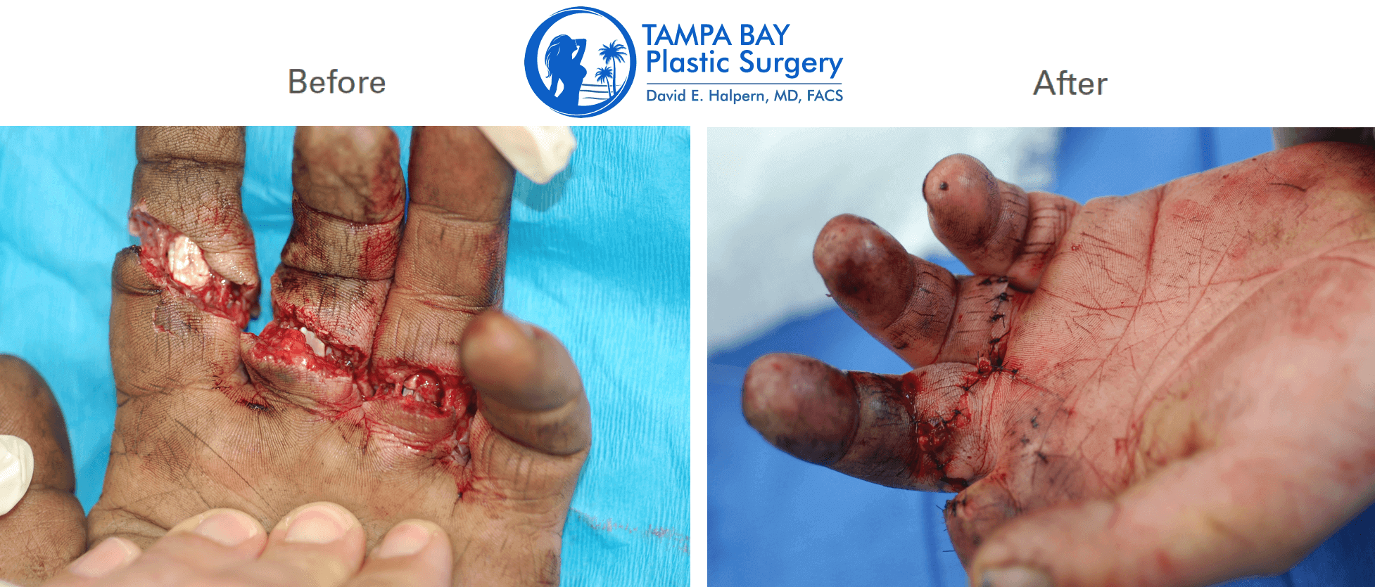 finger replant surgery tampa fl