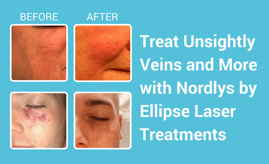 Nordlys by Ellipse Laser Treatments