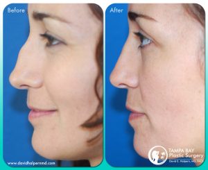 Rhinoplasty Tampa Bay Before After