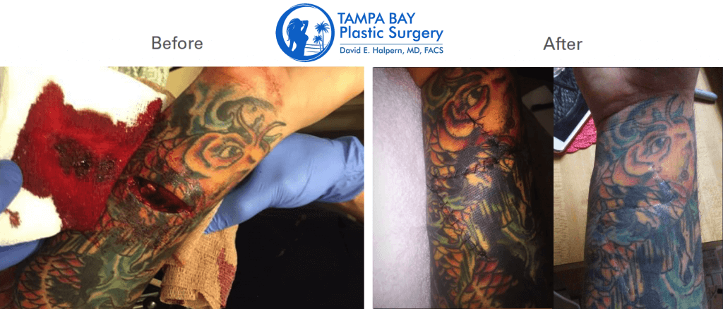 tendon nerve before after reconstructive surgery tampa