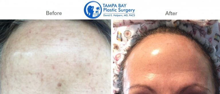 Tampa Nordlys Ellipse Laser before and after