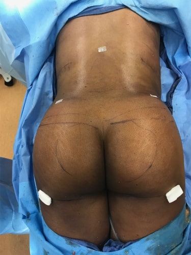 Buttock Augmentation Patient