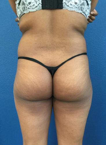 Buttock Augmentation Patient