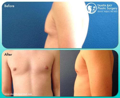 Gynecomastia Tampa Before and After