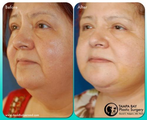 liposuction before after tampa
