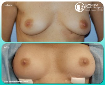 breast-augmentation-before-after-tampa-bay