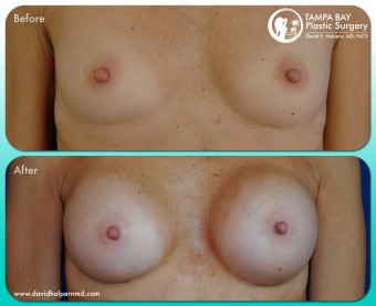 breast-augmentation-before-after-tampa-fl