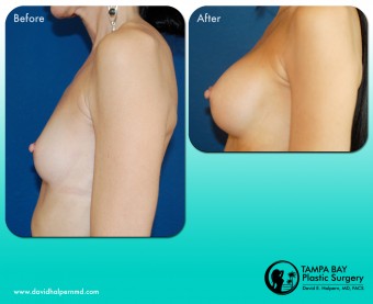 breast-augmentation-before-after-tampa-bay-area