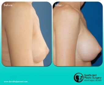 breast-augmentation-tampa-fl_-1