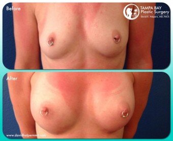 breast-augmentation-before-after-tampa-bay-area-1