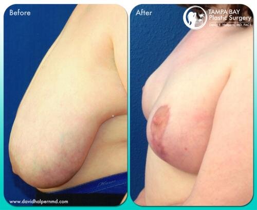 Breast Reduction Before After Tampa FL