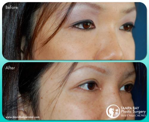 eyelid lift before after tampa fl