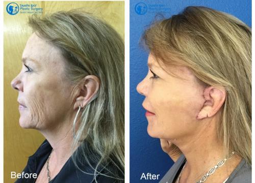 facelift-fat-transfer-before-after-tampa-left
