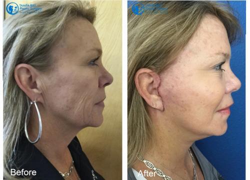 facelift-fat-transfer-before-after-tampa-right