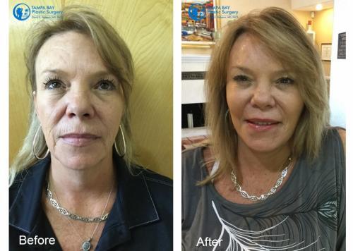 facelift-fat-transfer-before-after-tampa-front