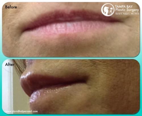 lip-augmentation-Tampa-Before-After