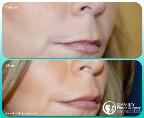 lip-implant-before-after-tampa-fl