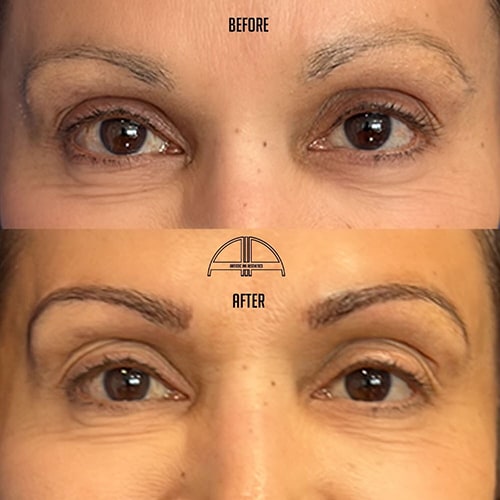 Strawberry-laser-treatment-before-after-tamp-bay-fl-