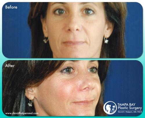 Strawberry-laser-treatment-before-after-tamp-bay-fl-
