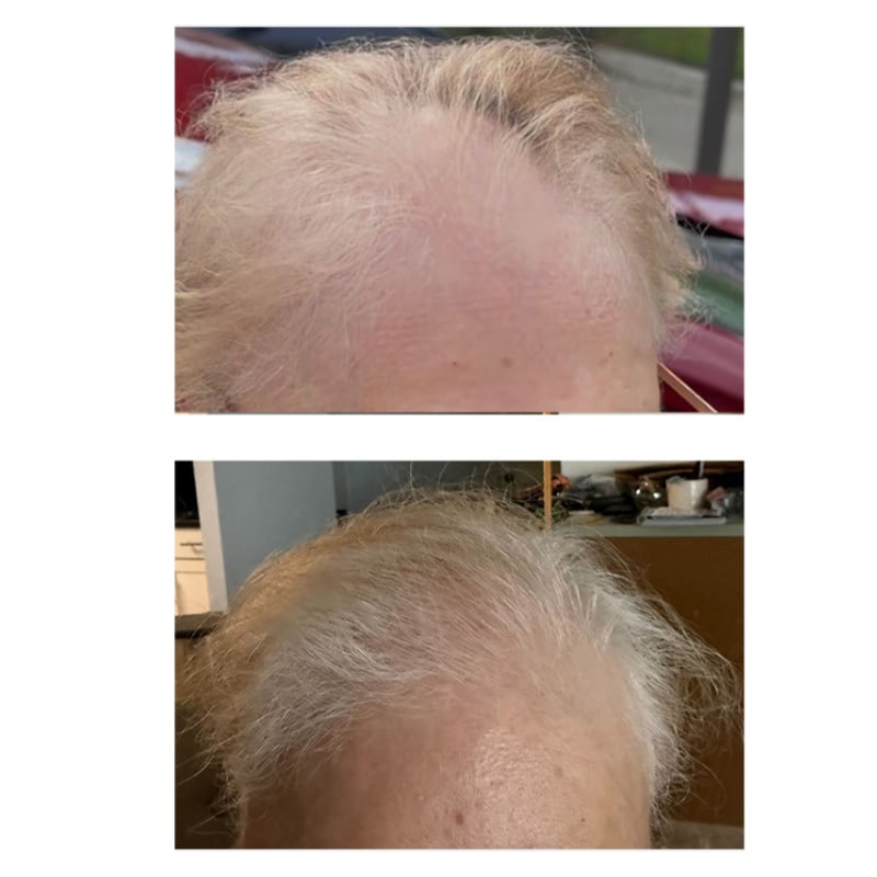 Hair-Restoration-with-Exosomes-before-after-tamp-bay-fl-