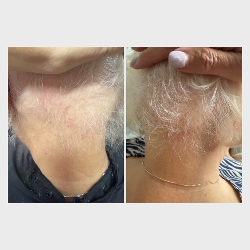 Hair-Restoration-with-Exosomes-before-after-tamp-bay-fl-