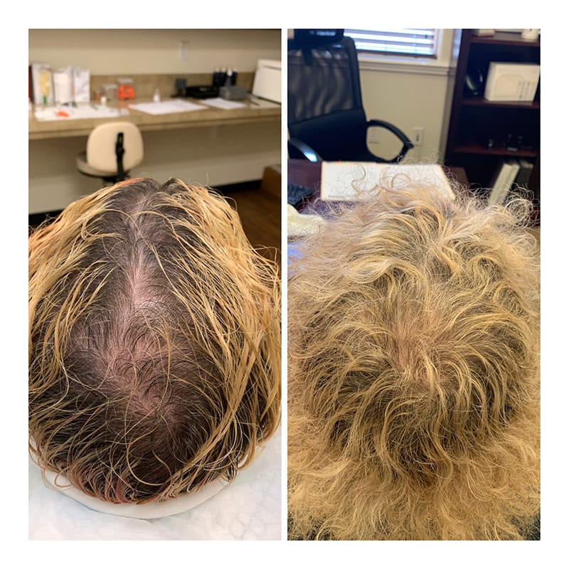 Hair-Restoration-with-Exosomes-before-after-tamp-bay-fl-