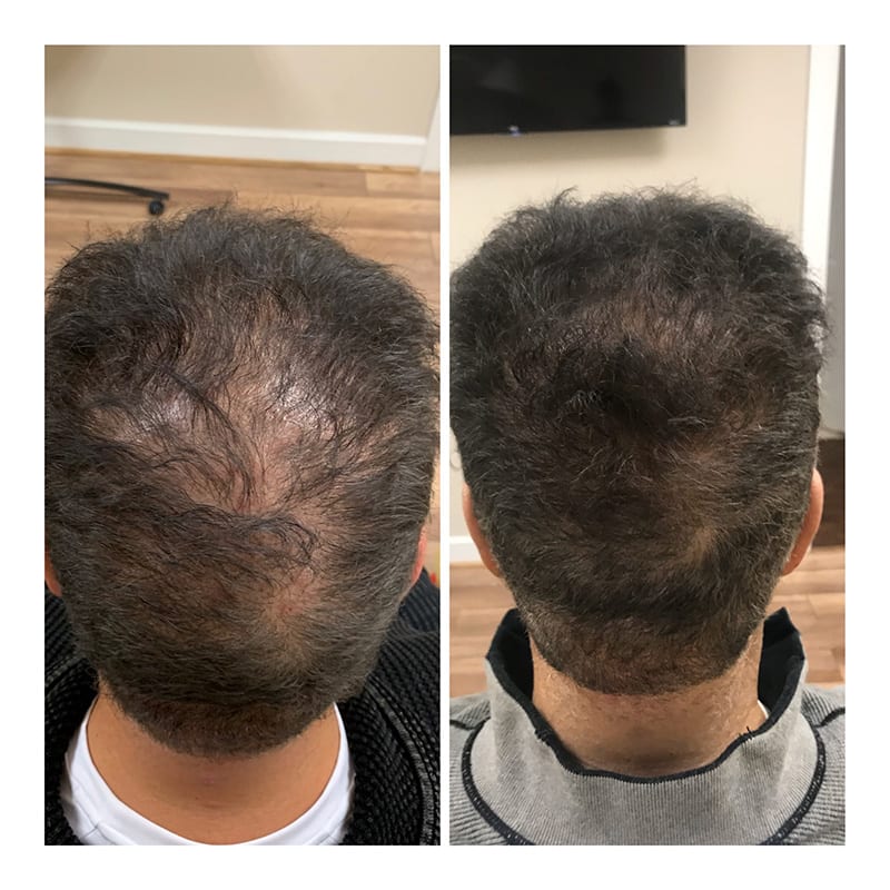 Hair-Restoration-with-Exosomes-before-after-tamp-bay-fl-